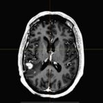 How Neuroradiology Assists in Diagnosing Rare Brain Disorders