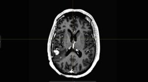 How Neuroradiology Assists in Diagnosing Rare Brain Disorders