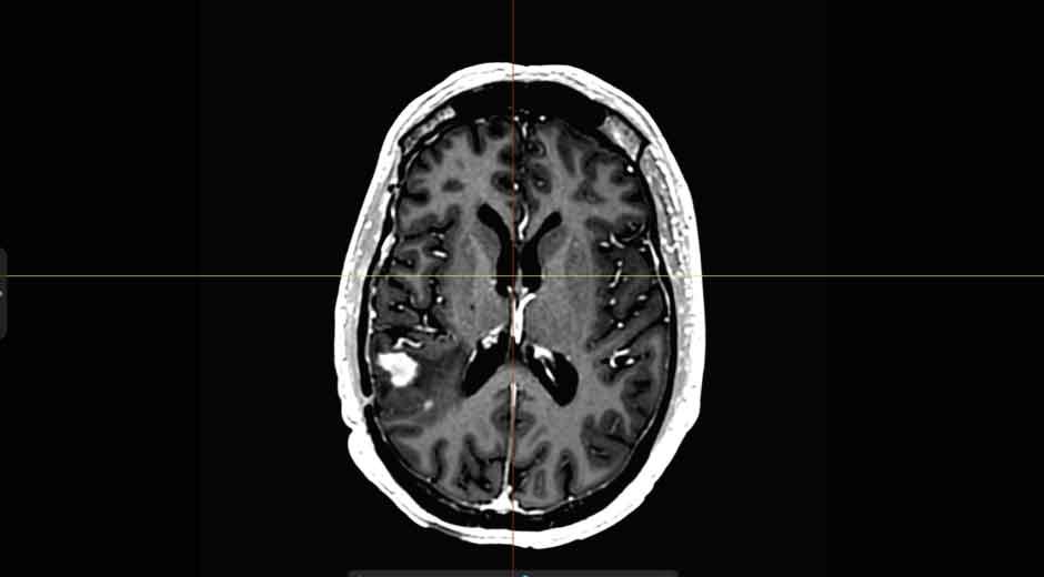 How Neuroradiology Assists in Diagnosing Rare Brain Disorders