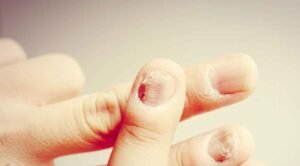 Understanding Gingerbread Nails Fungus